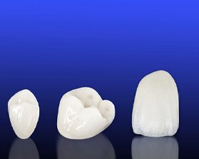 all-ceramic dental crown