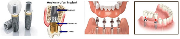 anatomy of implant