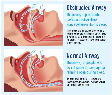 obstructed airway and normal airway