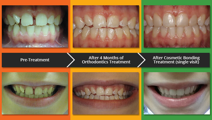 orthodontics before after and cosmetic bonding