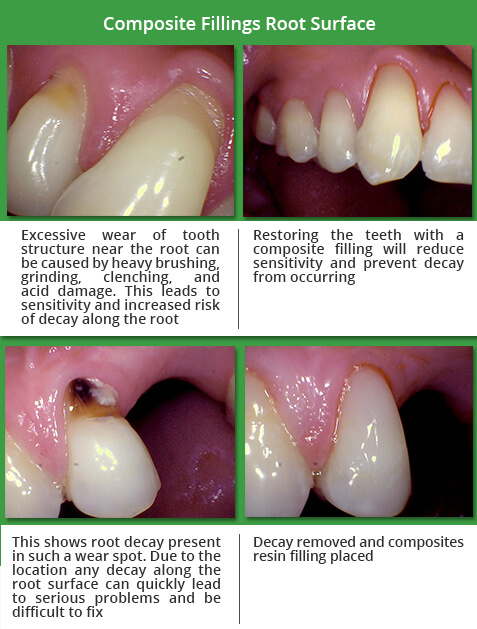 composite fillings root surface before and after