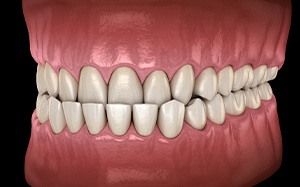 Illustration of an underbite