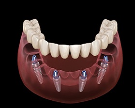 Illustration of arch of prosthetic teeth and All-on-4 implants
