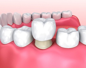 dental crown