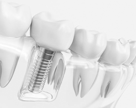 Model of dental implant