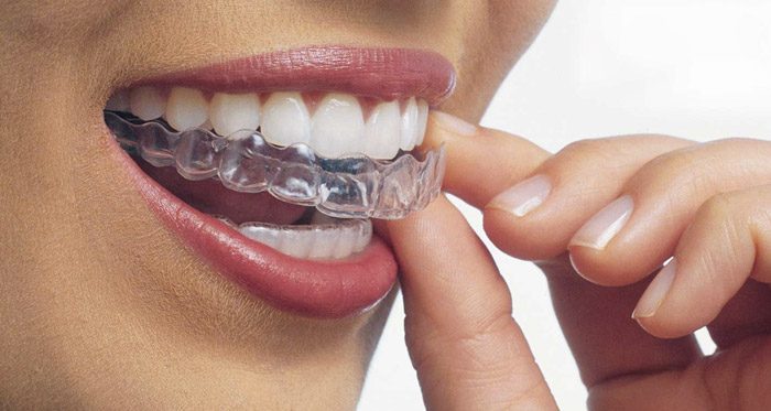 free invisalign consult