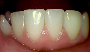 after ceramic crown