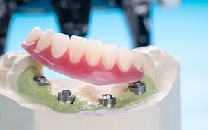 Implant denture sitting on a plaster model 