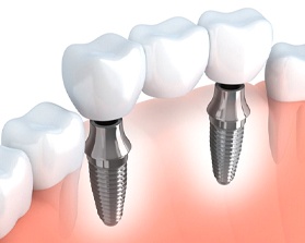 An implant-retained dental implant.