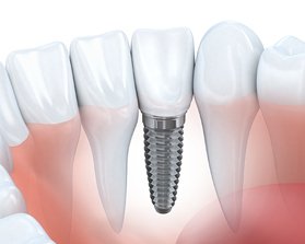 Animation of implant supported dental crown