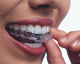 woman putting in invisalign