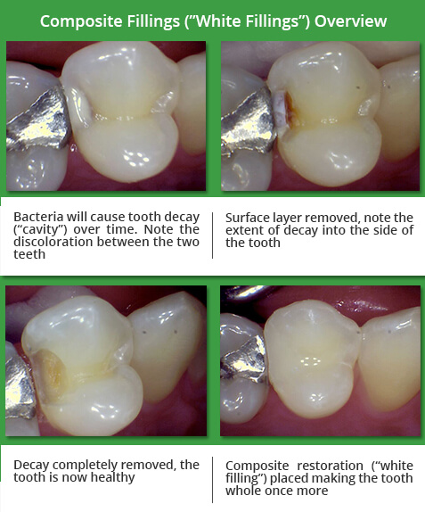 cavity side of molar