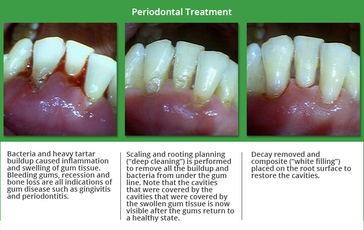 periodontal therapy