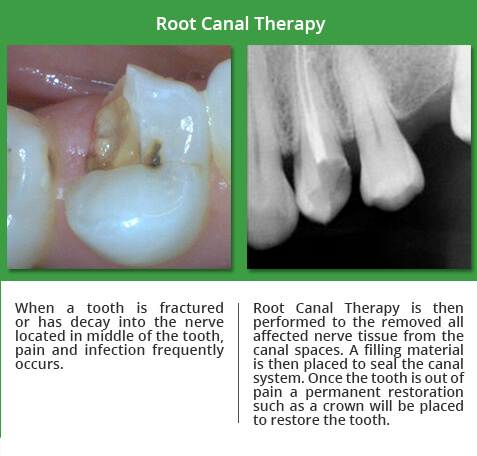 before and after root canal therapy