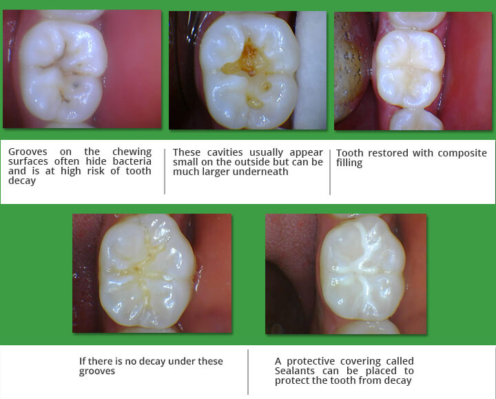 dental sealant before during and after