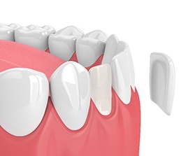 Illustration of veneer being placed on front tooth