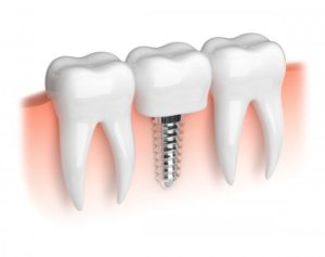 Illustration of dental implant.