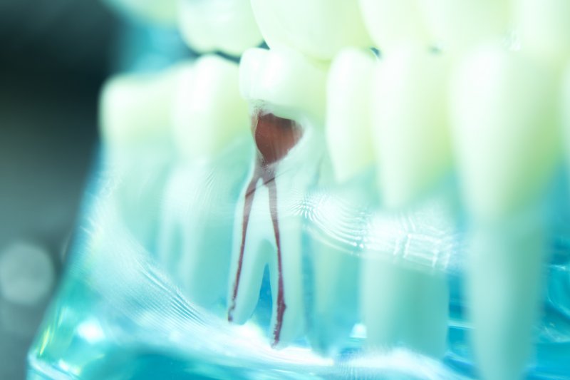 X-ray of infected tooth root