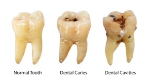 Dentist in Bothell showing different stages of decay.