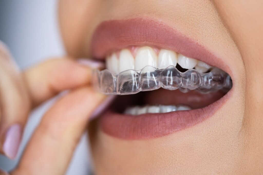 Closeup of woman's fingers removing Invisalign from upper arch